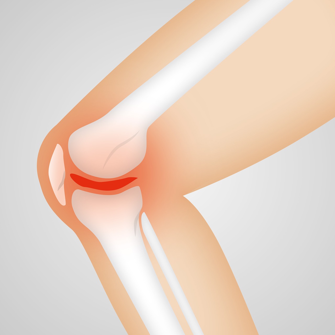 Quels sont les différents types d&rsquo;arthrose ?