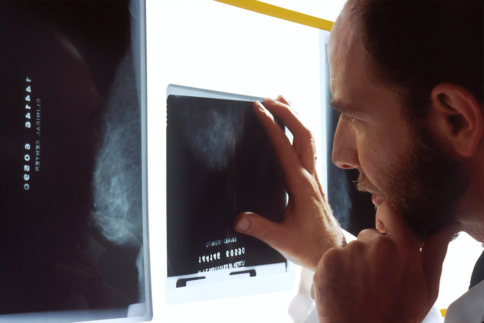 Mieux comprendre le cancer colorectal : causes, symptômes etc.